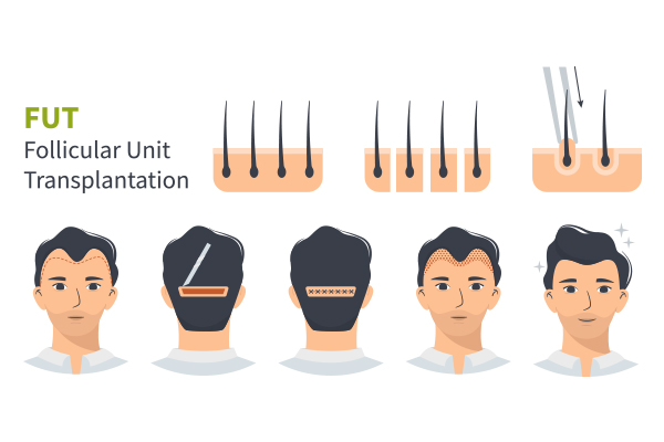Hair Transplant Method