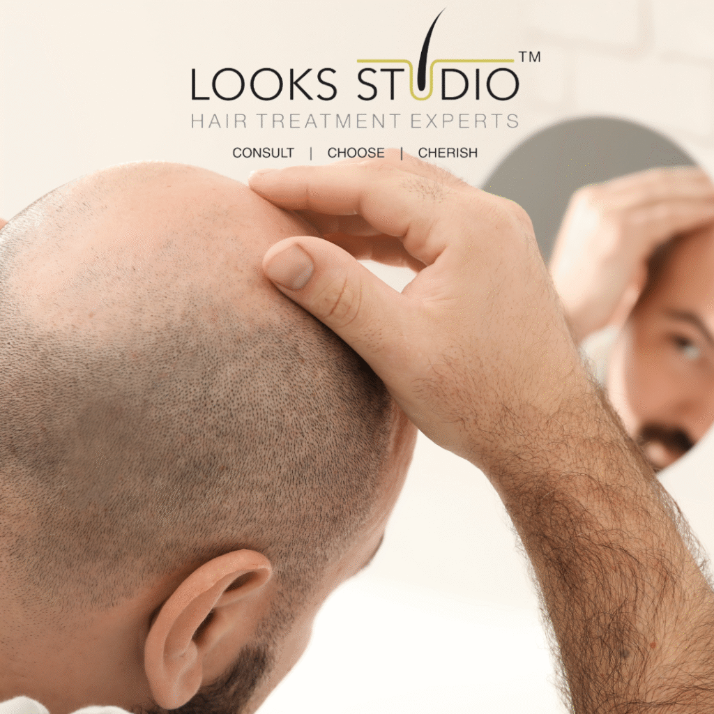 Hair Transplant In Chennai