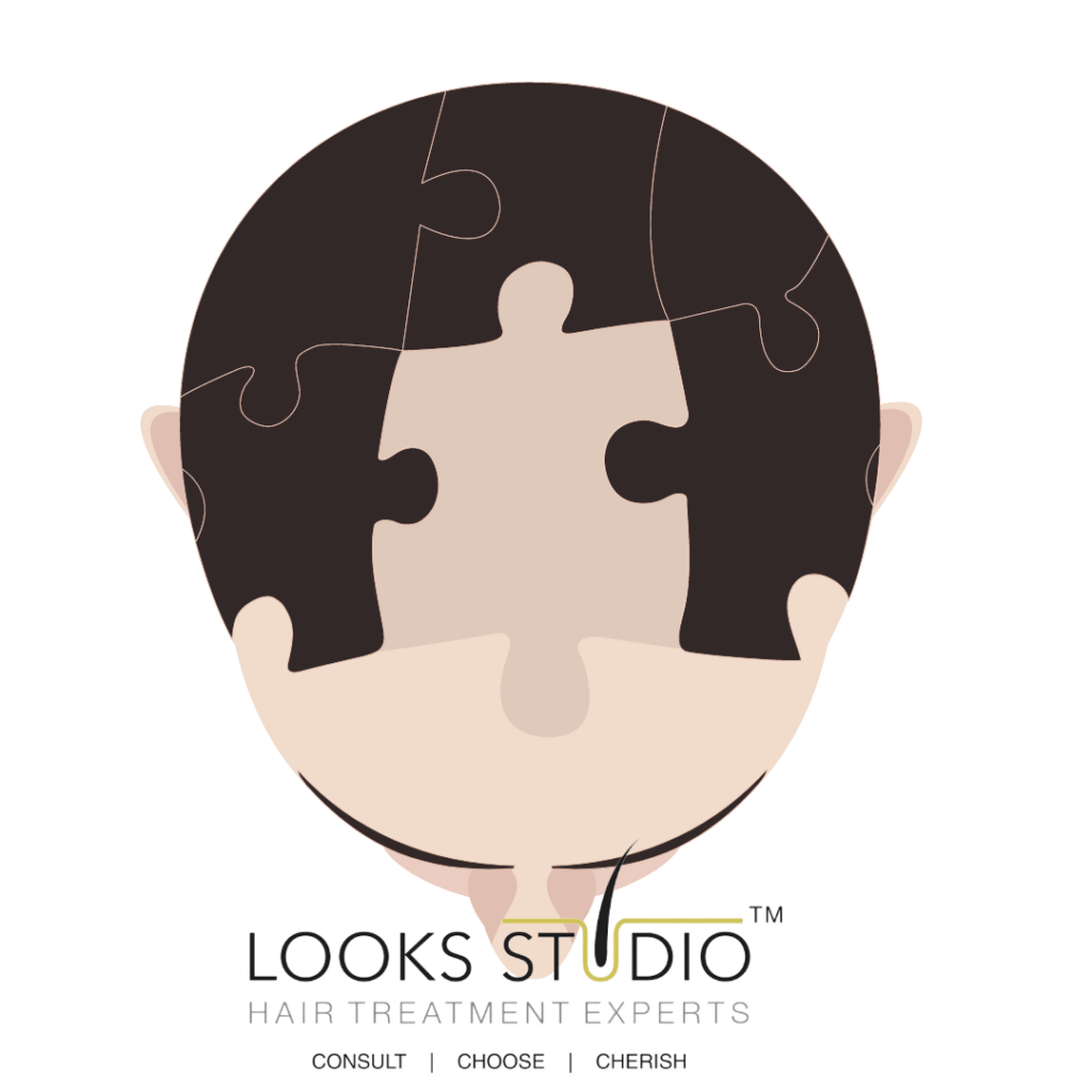 Male Pattern Baldness