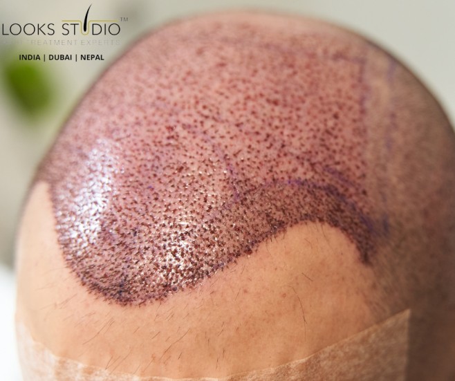 Is Platelet-Rich Plasma (PRP) Better Than Hair Transplant?