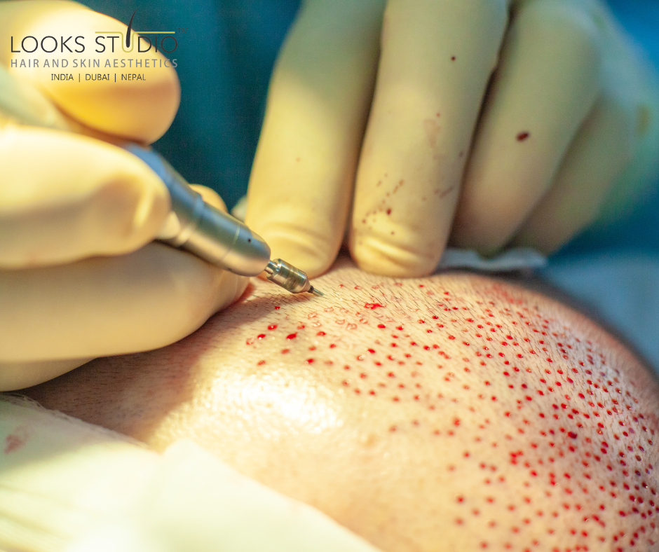 failed hair transplants