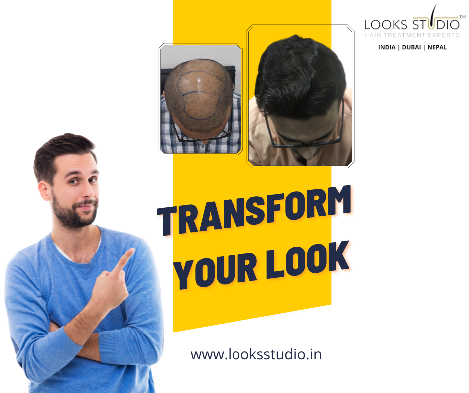 Non-Surgical Hair Replacement