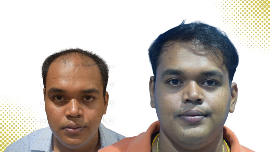 Hair Transplant Results: Looks Studio Hair Transplant