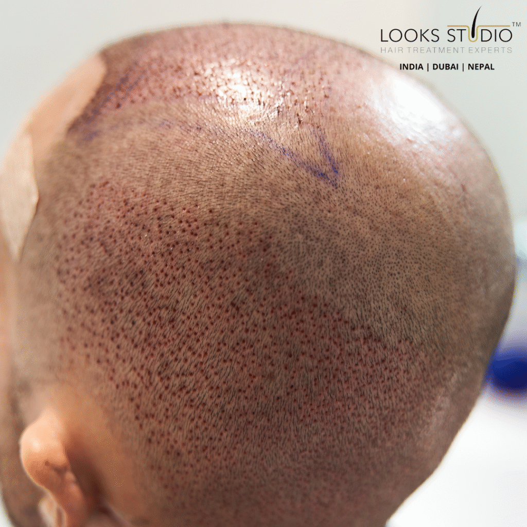 Myth of Painful Hair Transplants