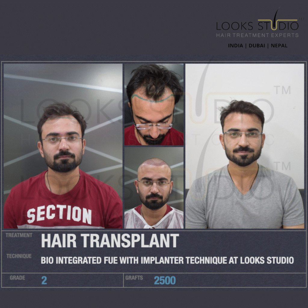 Price of Hair Transplant