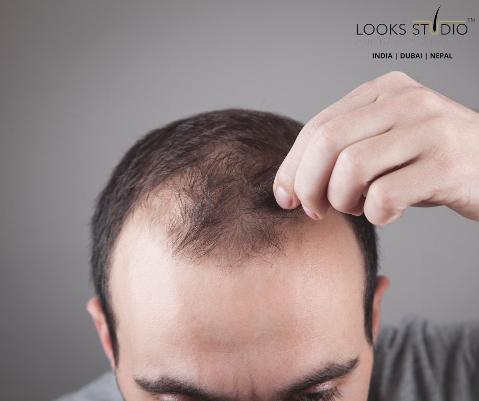 Genetic Inheritance of Hair Loss