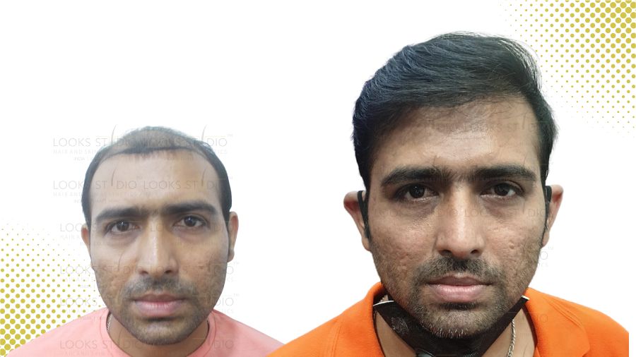Ahmedabad hair transplant