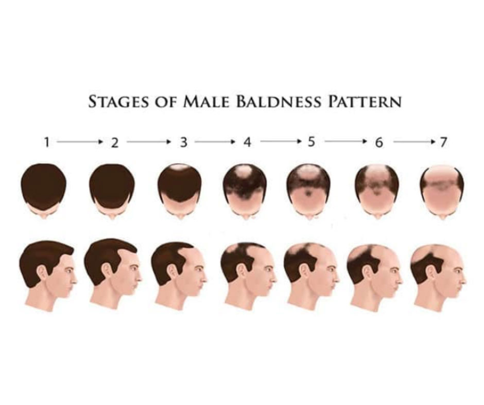 Understanding the Stages of Baldness