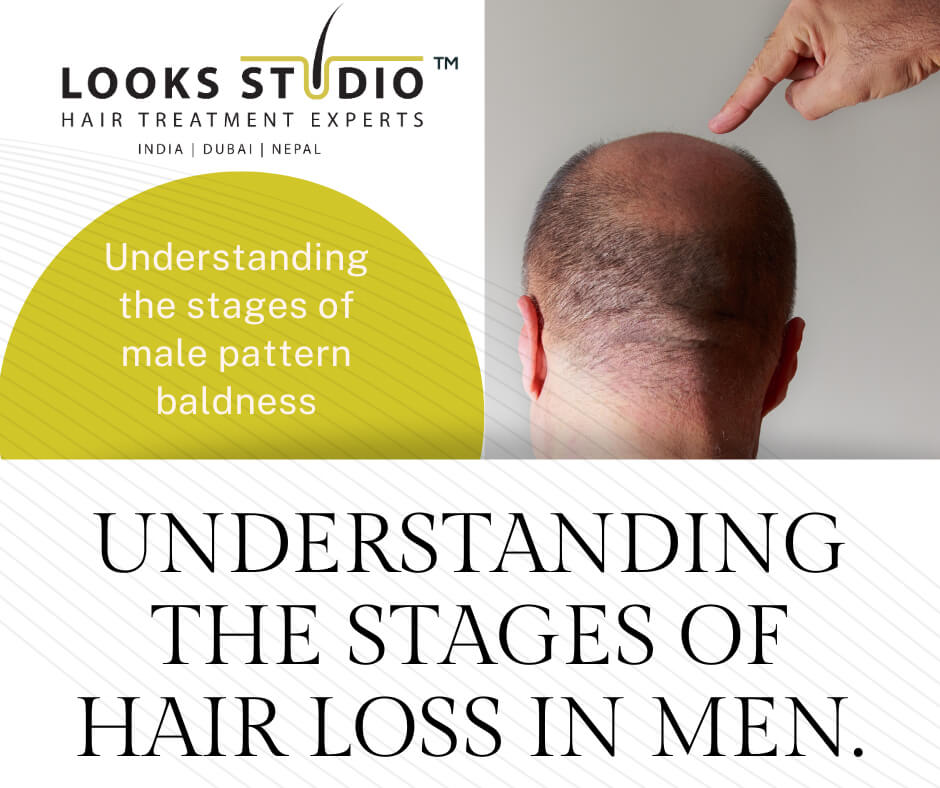 Hair Loss Stages