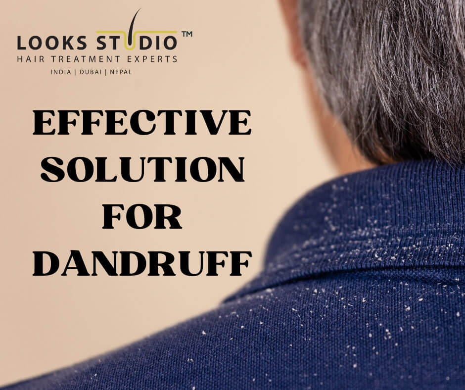 effective-solution-for-dandruff