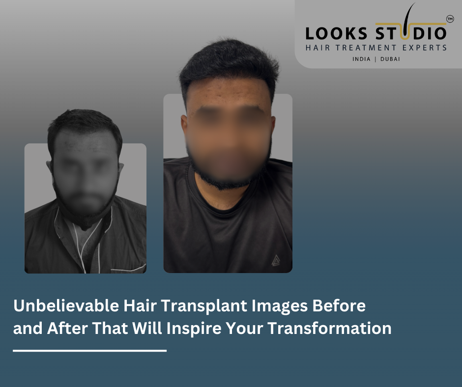 Unbelievable Hair Transplant Images Before and After