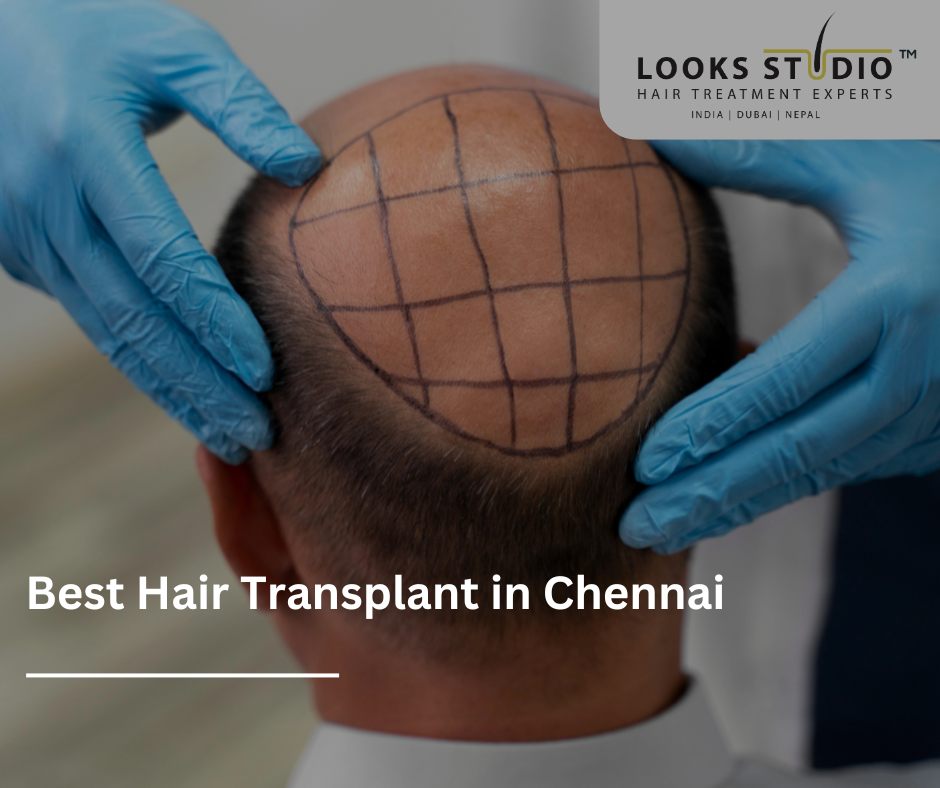 Best Hair Transplant in Chennai