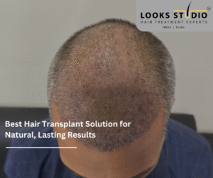 Best Hair Transplant Solution: Looks Studio