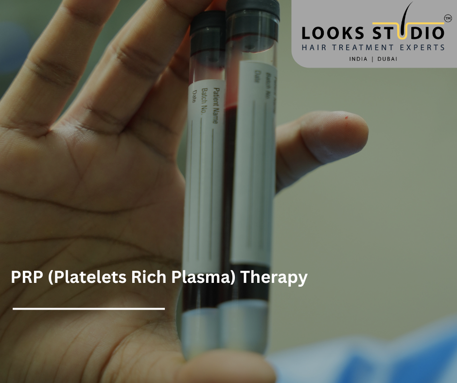 PRP hair loss treatment