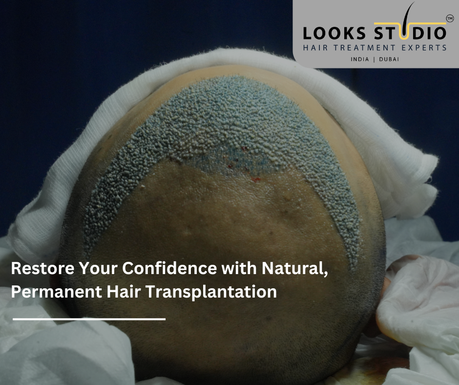 Restore Your Confidence with Natural, Permanent Hair Transplantation