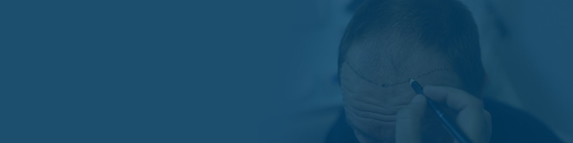 Body to Head Hair Transplant